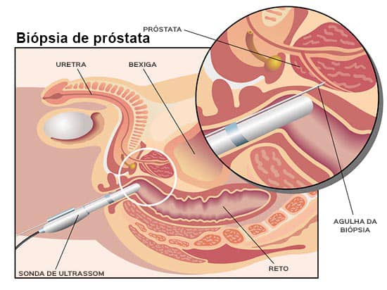 Imagem da biópsia de próstata